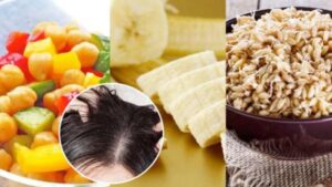 Diet plan for removing dandruff